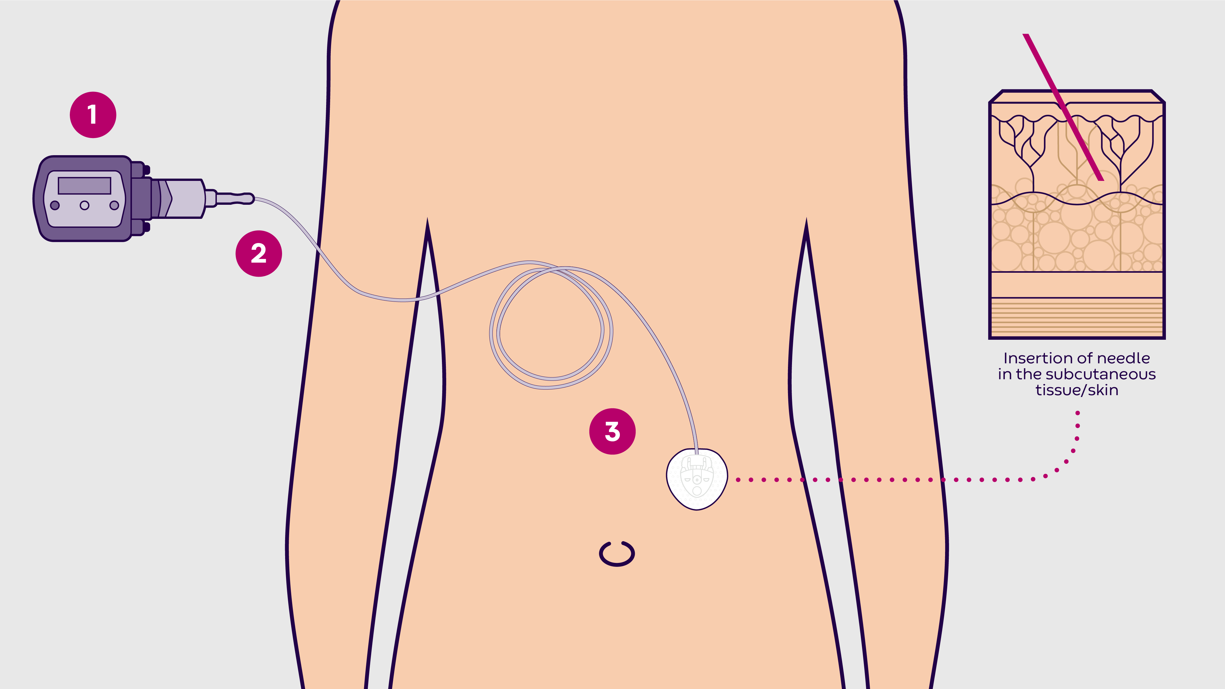 Image of the subcutaneous infusion process