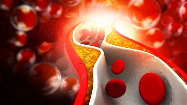 Das Bild zeigt Cholesterinplaque in Arterien.