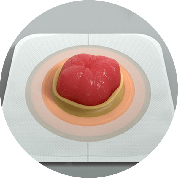 umiestnenie tvarovateľnej podložky na stómiu 